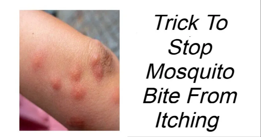 Trick To Stop Mosquito Bite From Itching 