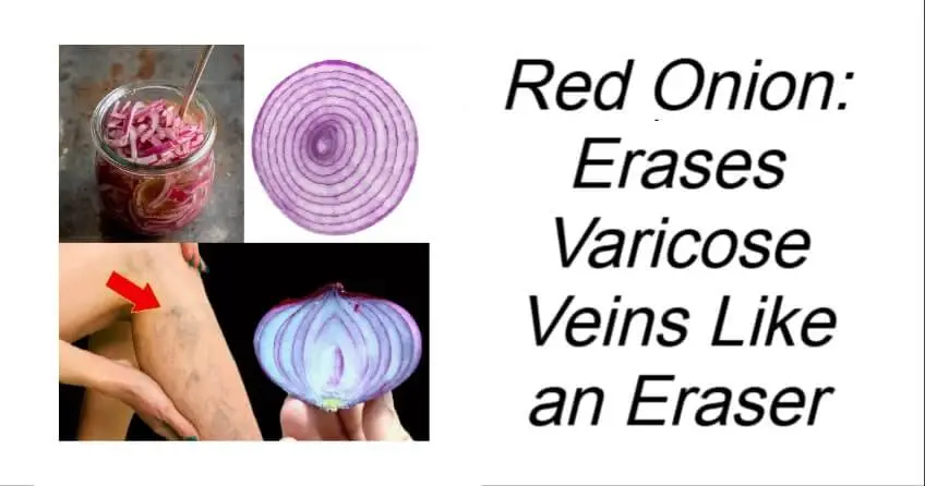 Red Onion Erases Varicose Veins Like an Eraser