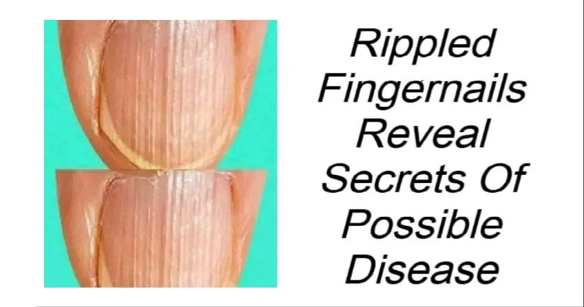 Rippled Fingernails Reveal Secrets Of Possible Disease