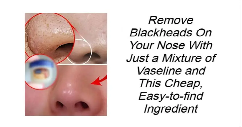 Remove Blackheads On Your Nose